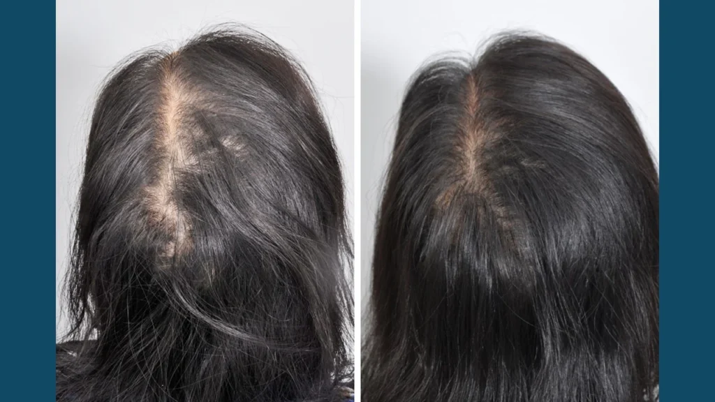 Real patient before and after hair loss treatment