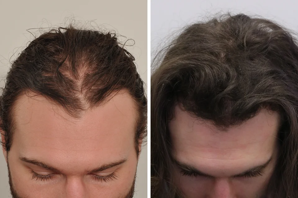 Real male patient before and after hair transplant procedure