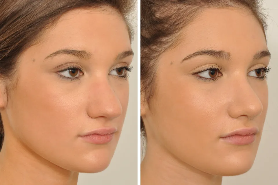 Rhinoplasty