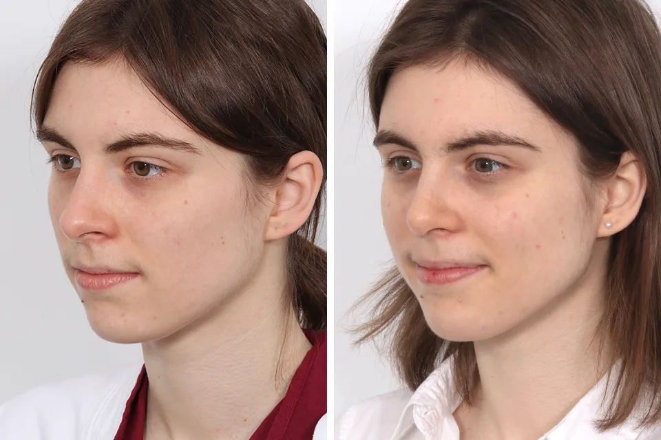 Rhinoplasty