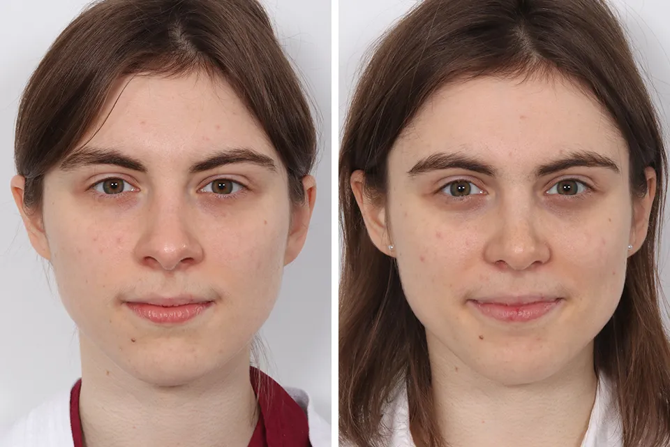 Rhinoplasty