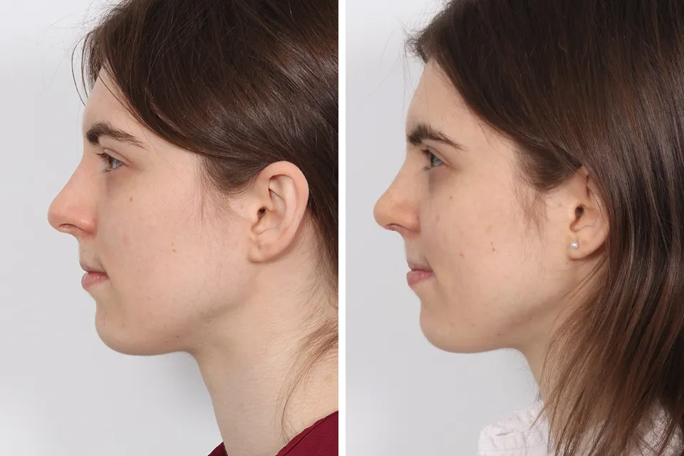 Rhinoplasty