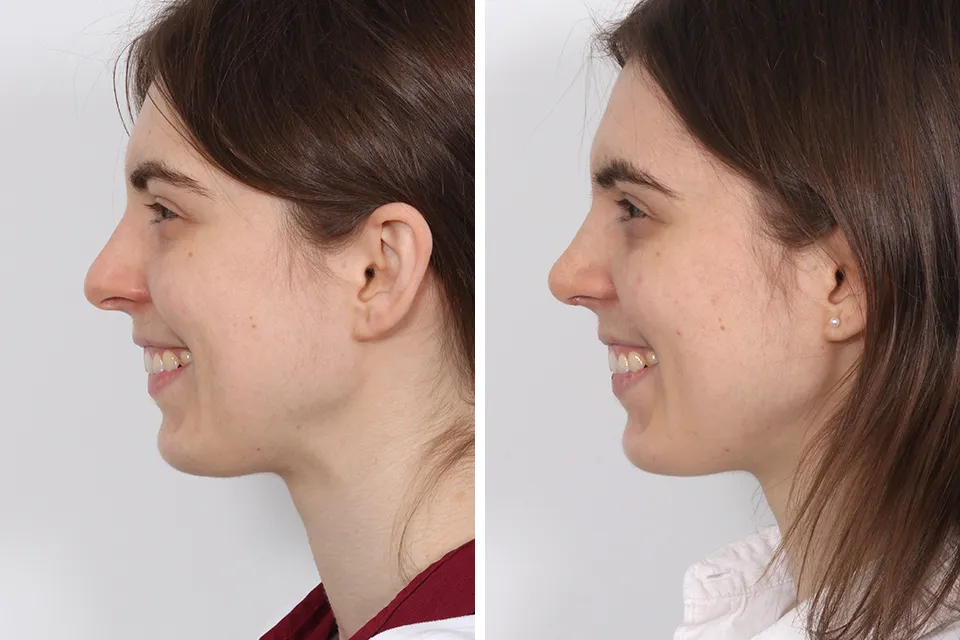 Rhinoplasty