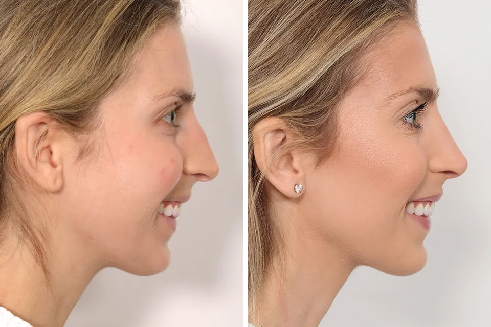 Rhinoplasty