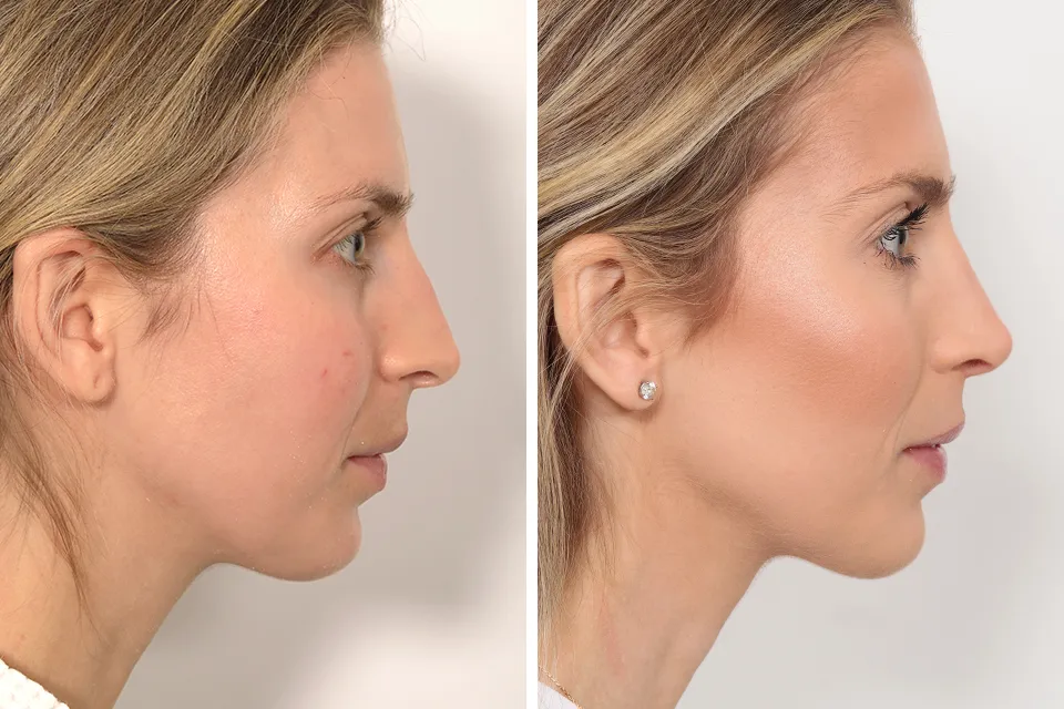 Rhinoplasty