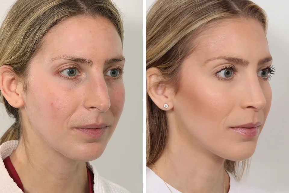 Rhinoplasty