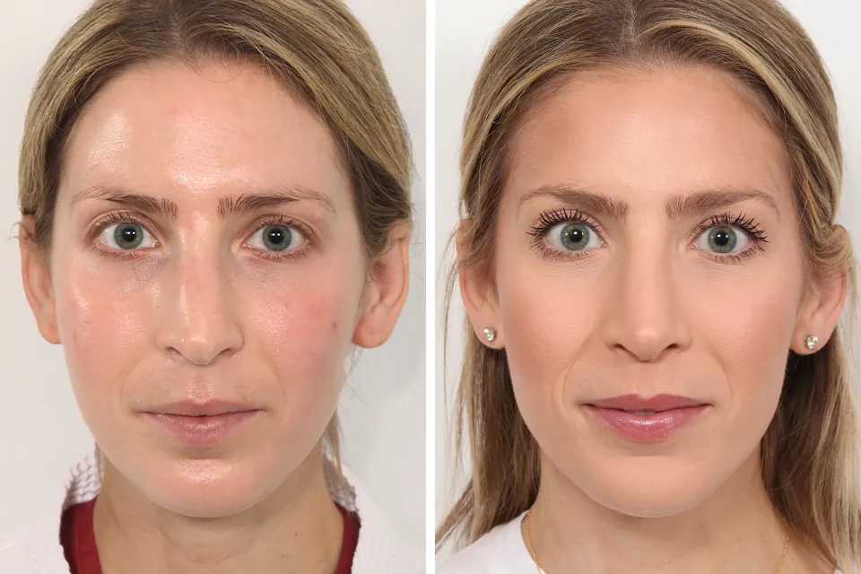 Rhinoplasty