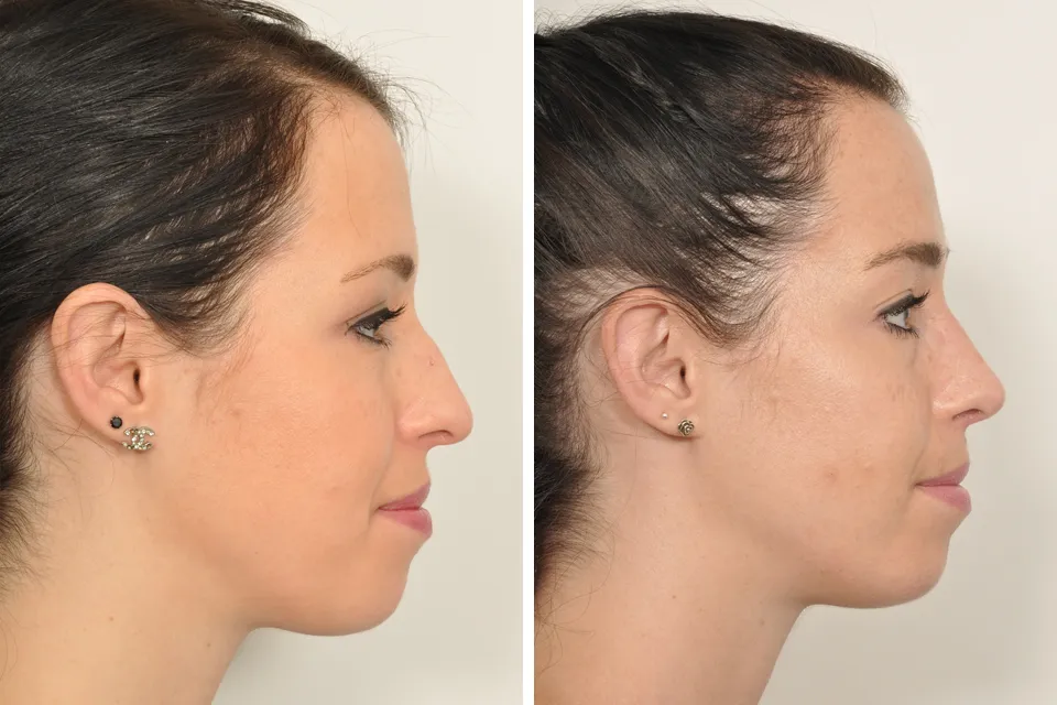 Rhinoplasty