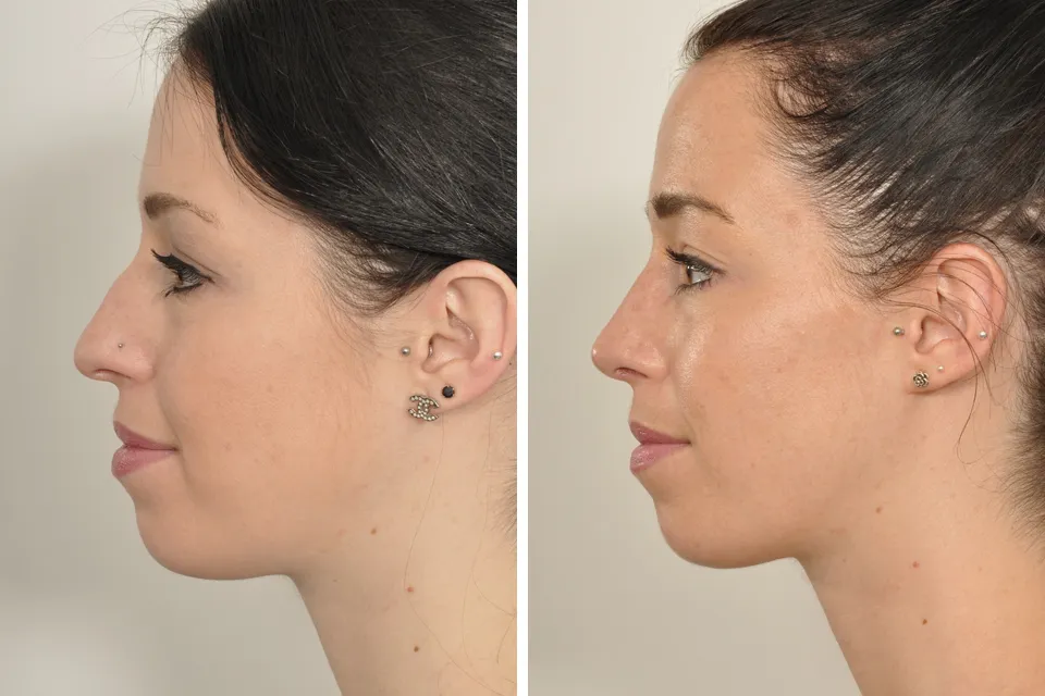 Rhinoplasty