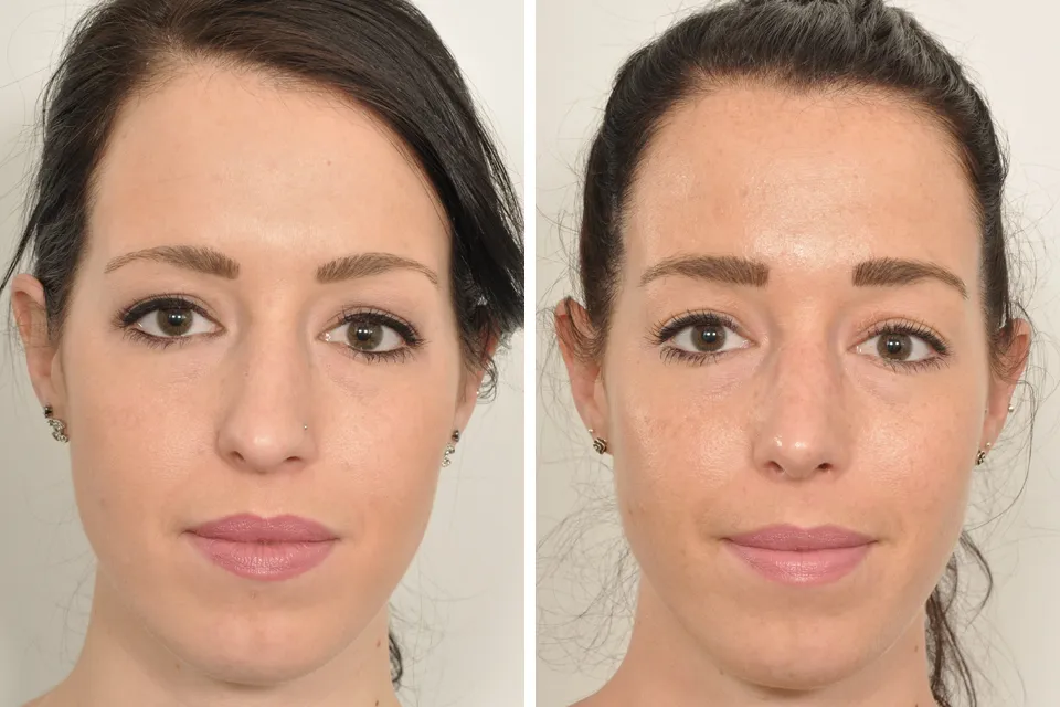 Rhinoplasty