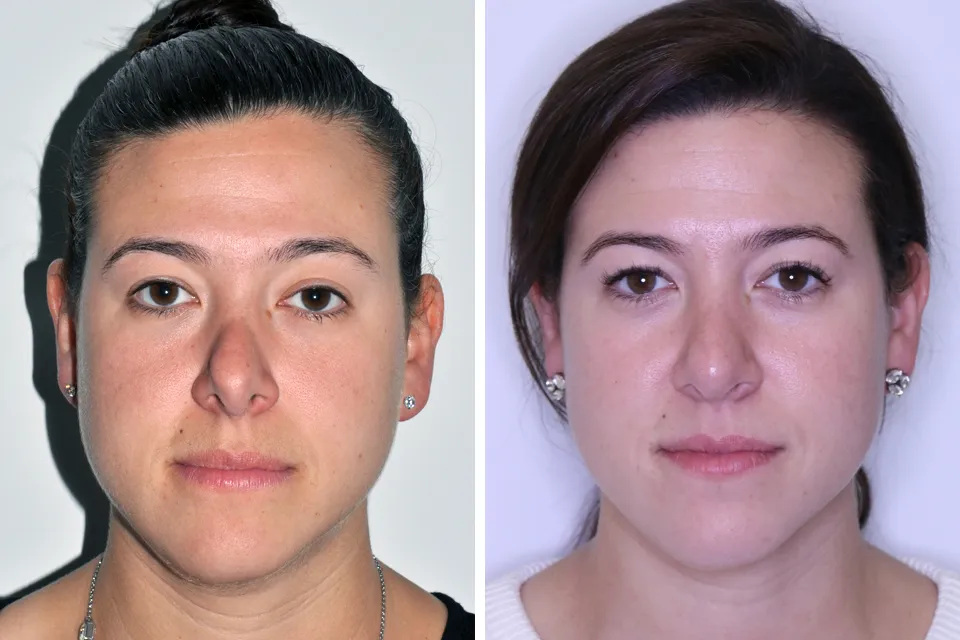 Rhinoplasty