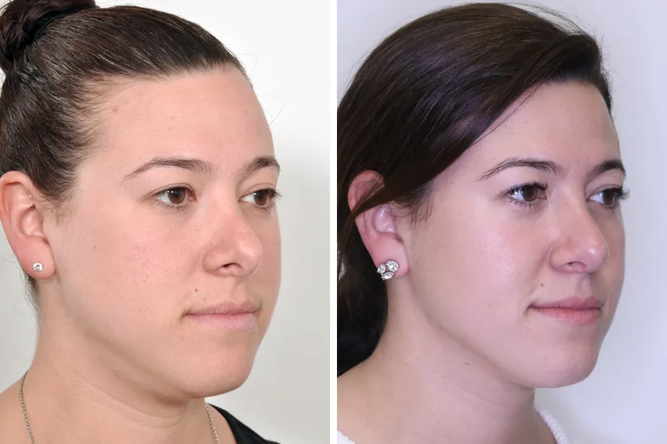 Rhinoplasty