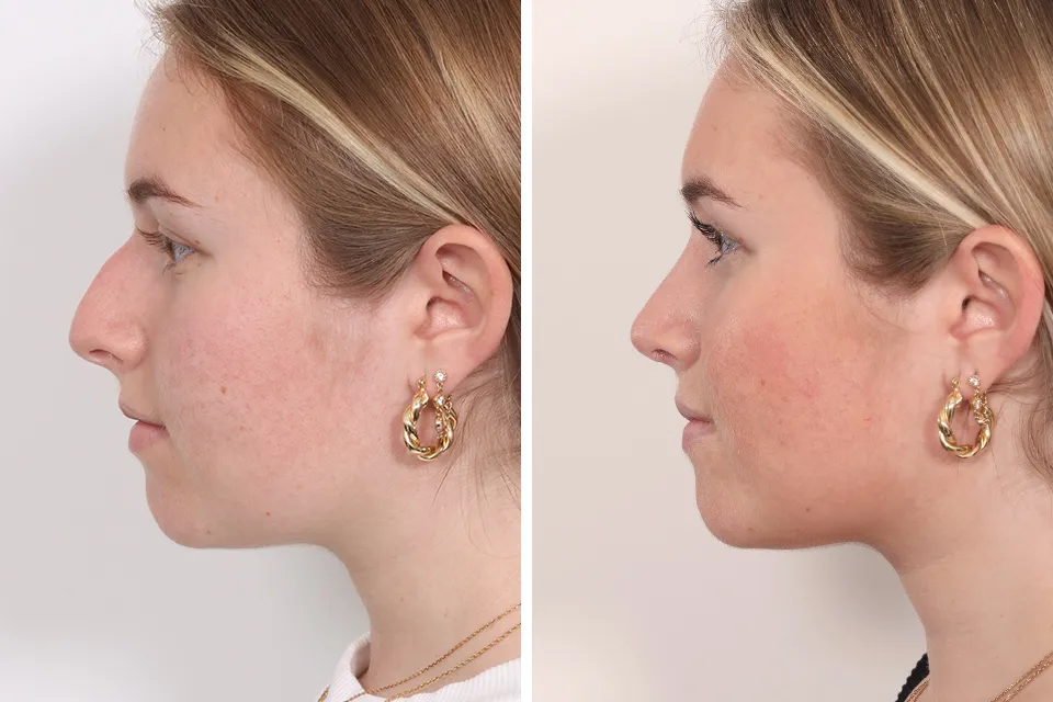 Rhinoplasty