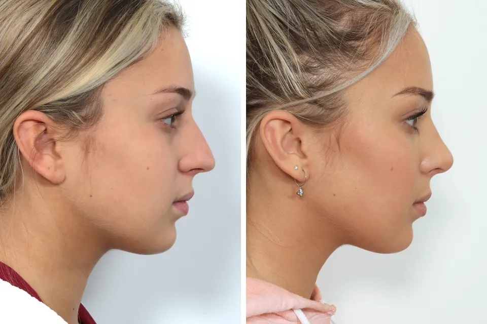 Rhinoplasty