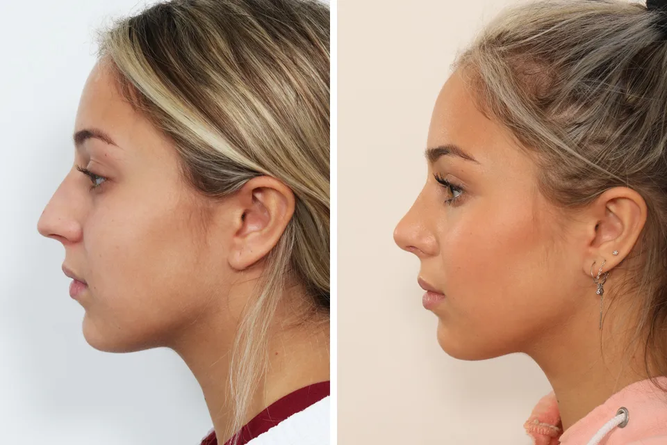 Rhinoplasty