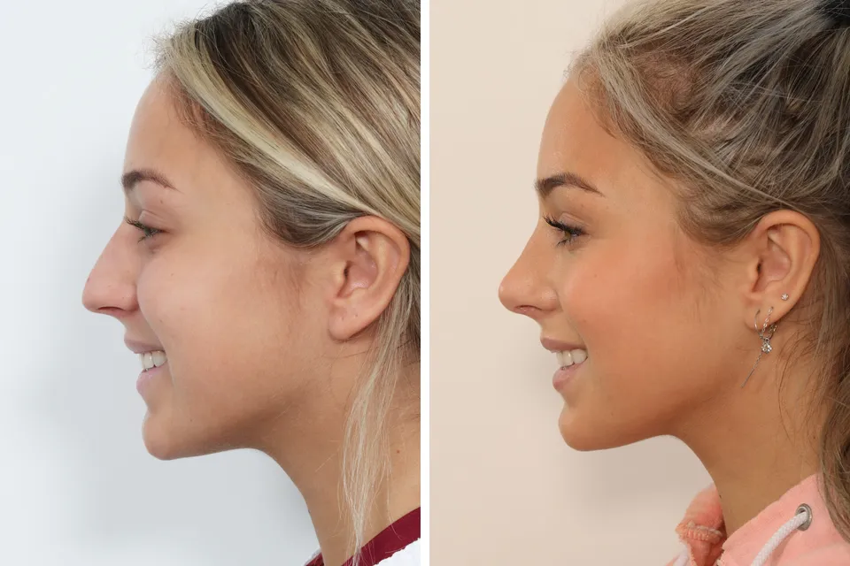 Rhinoplasty