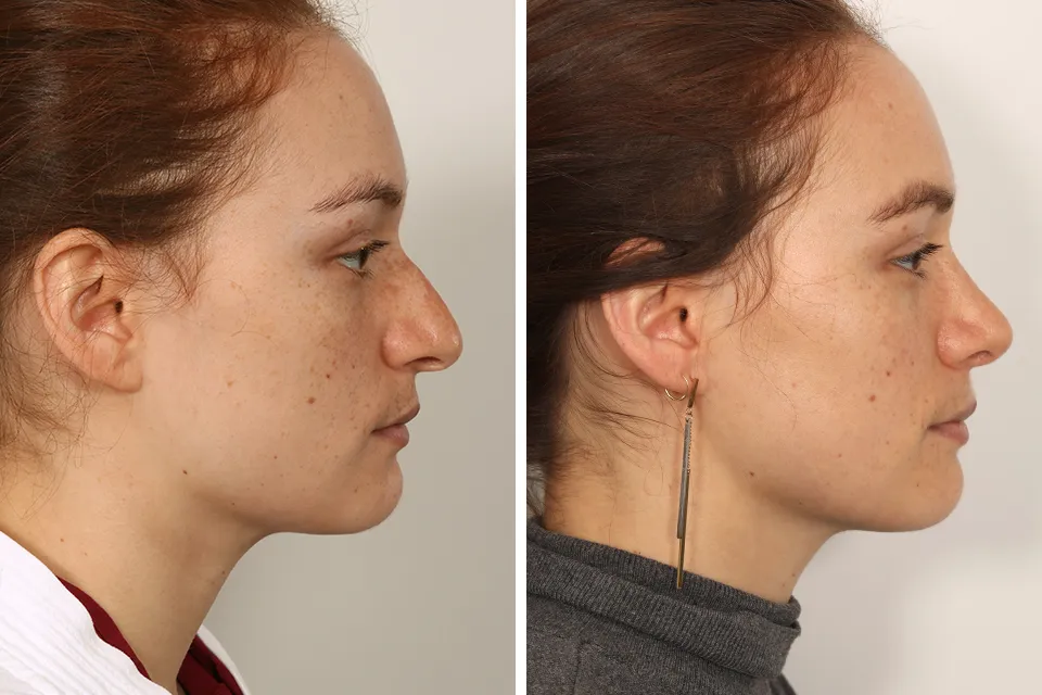 Rhinoplasty