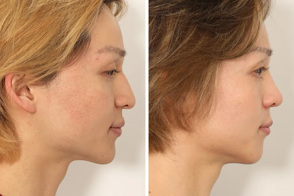 Male Rhinoplasty