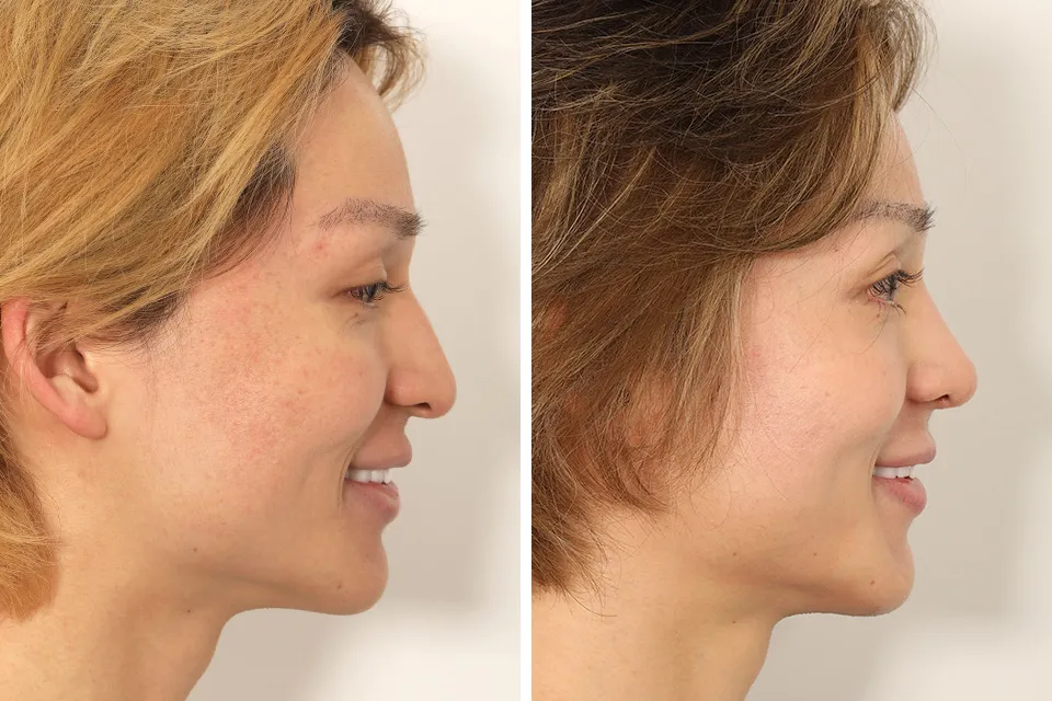 Male Rhinoplasty