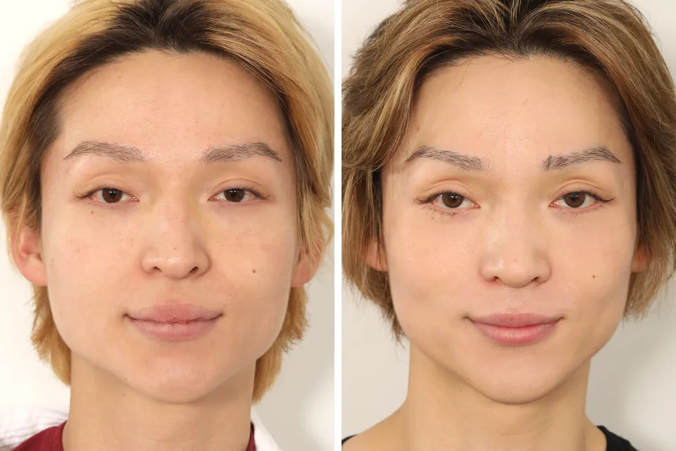 Male Rhinoplasty