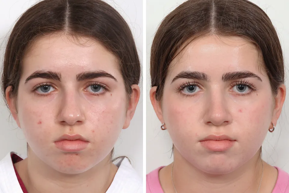 Rhinoplasty