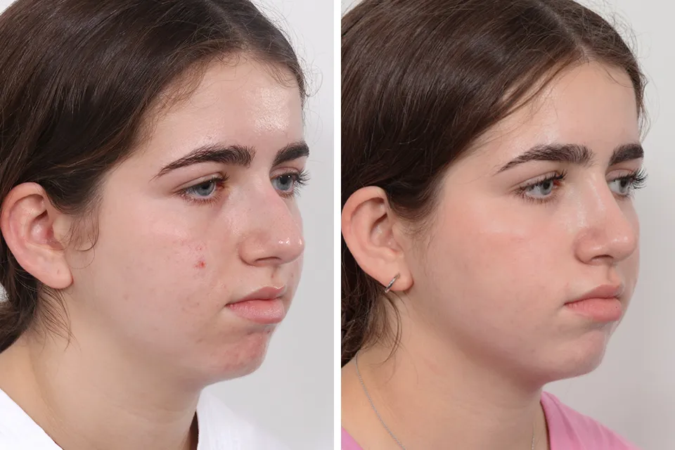 Rhinoplasty