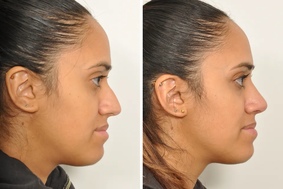 Rhinoplasty