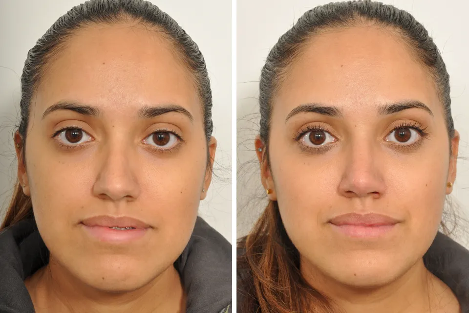 Rhinoplasty