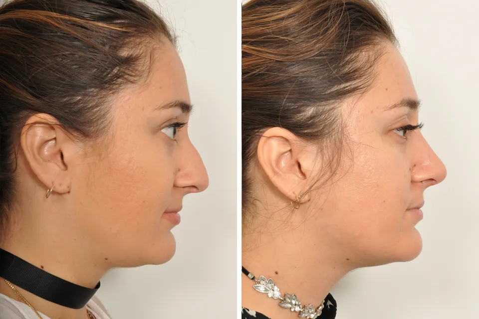 Rhinoplasty