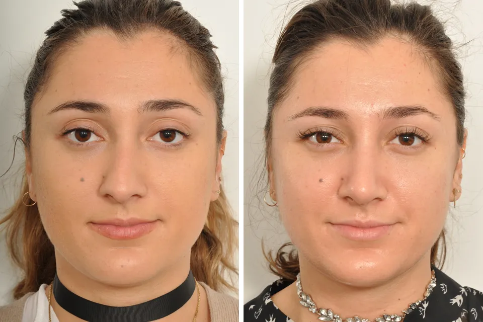 Rhinoplasty