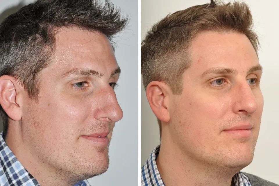 Male Rhinoplasty