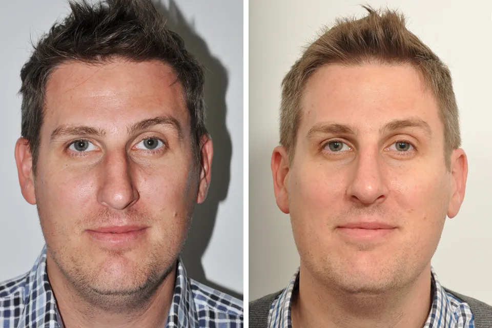 Male Rhinoplasty