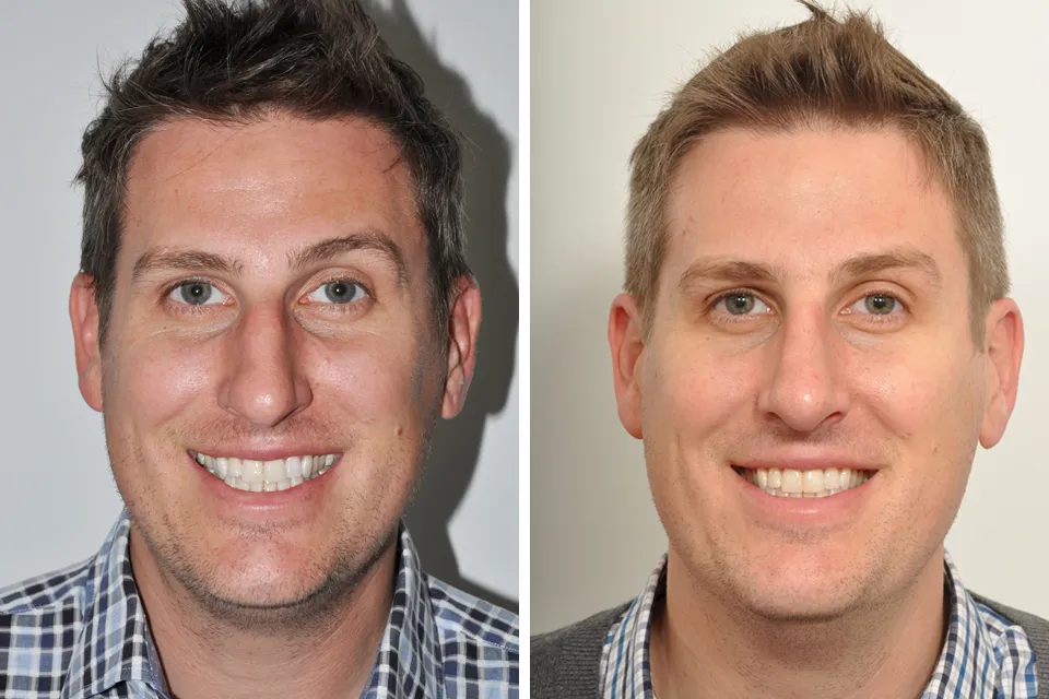 Male Rhinoplasty