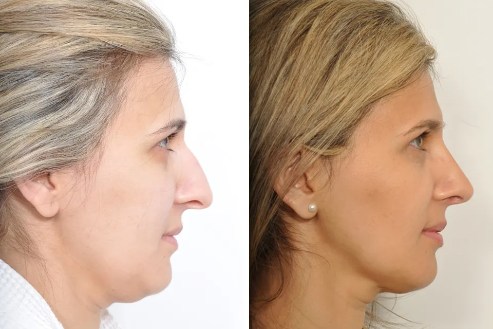 Rhinoplasty