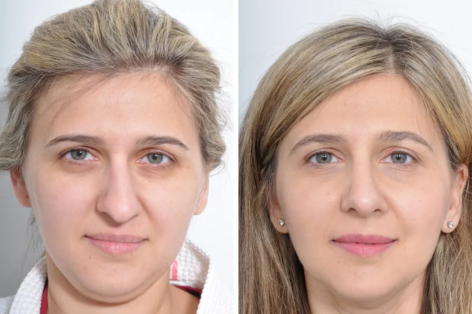 Real female patient Rhinoplasty front view
