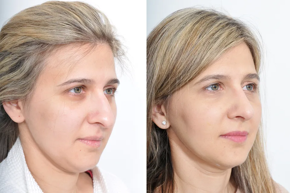 Rhinoplasty