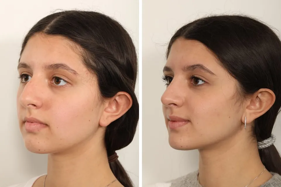 Rhinoplasty