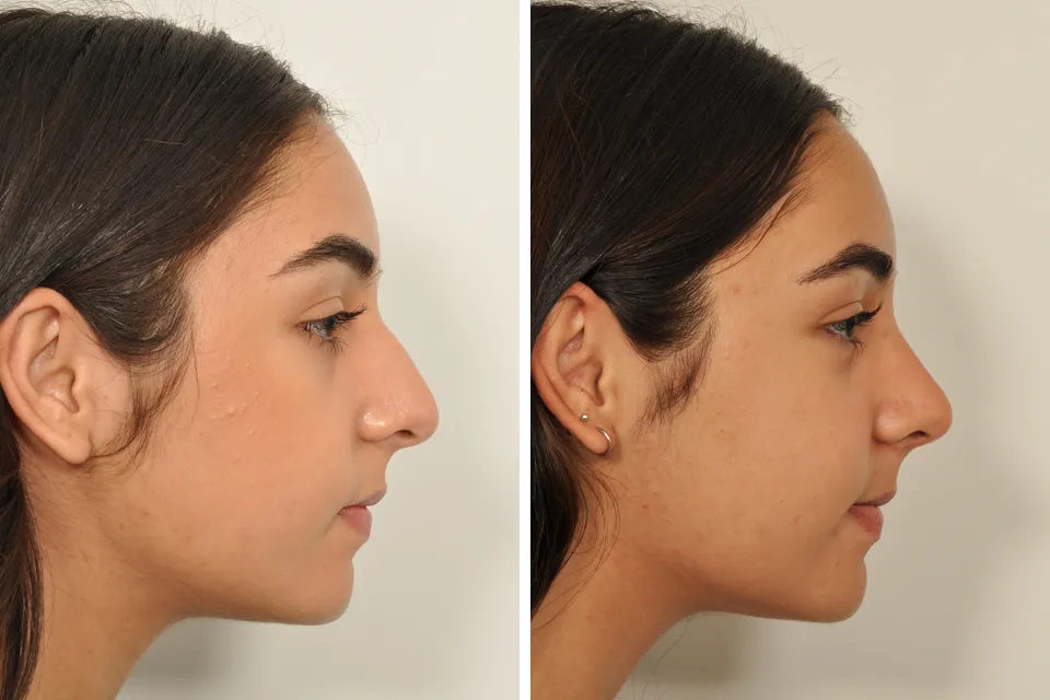 Rhinoplasty