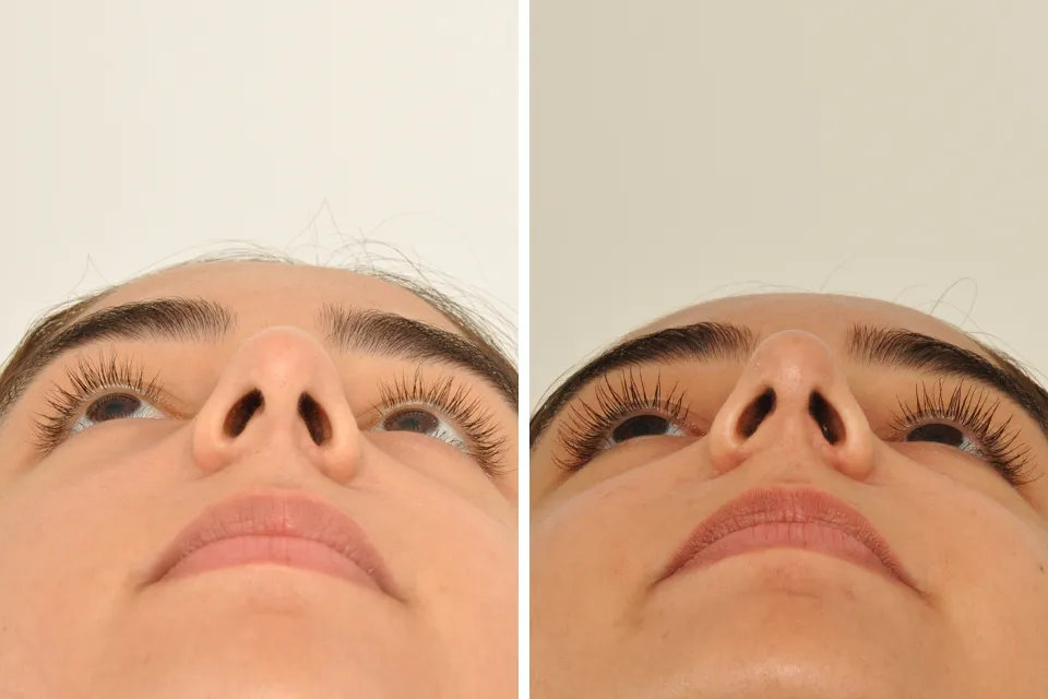 Rhinoplasty