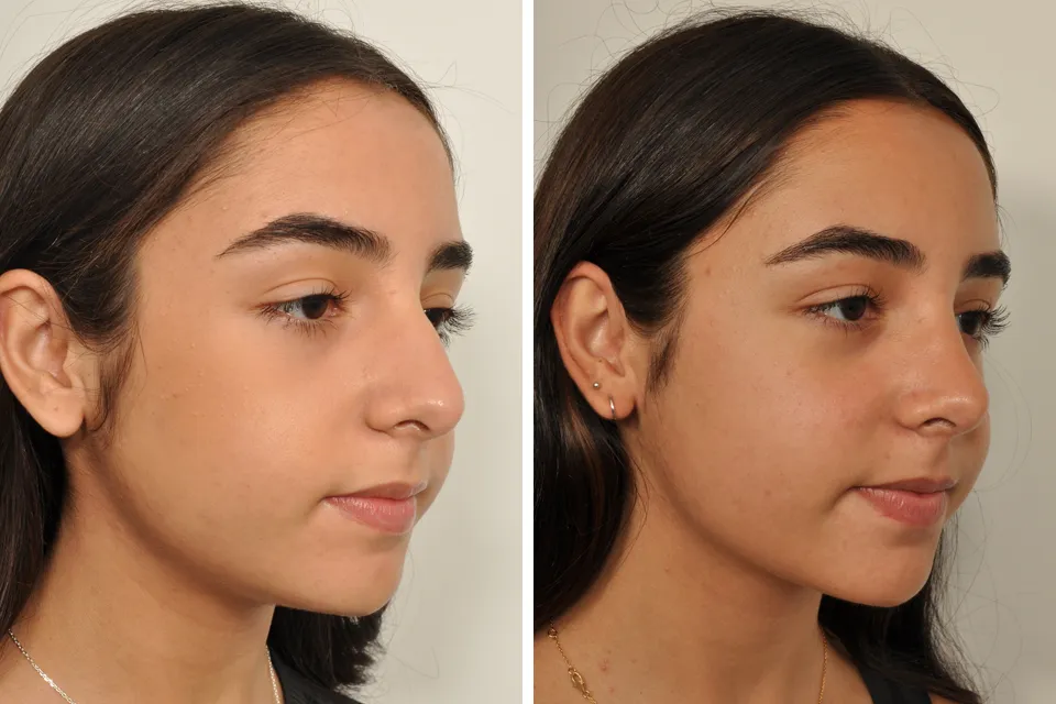 Rhinoplasty