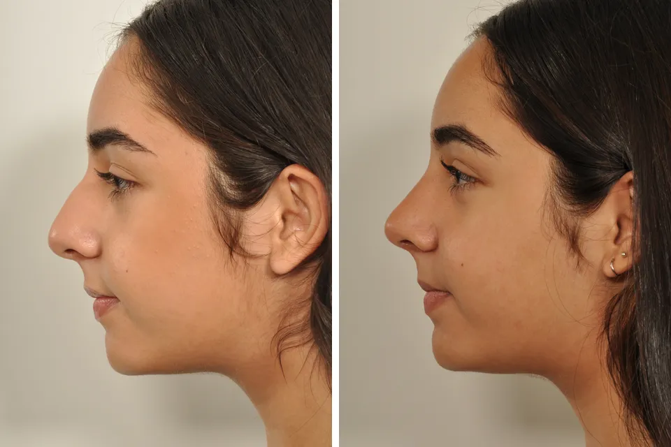 Rhinoplasty