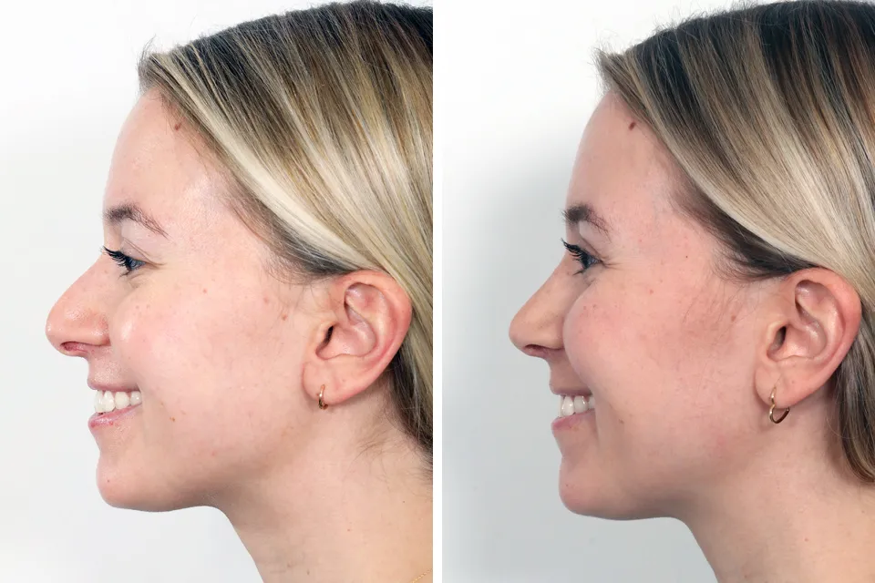 Rhinoplasty