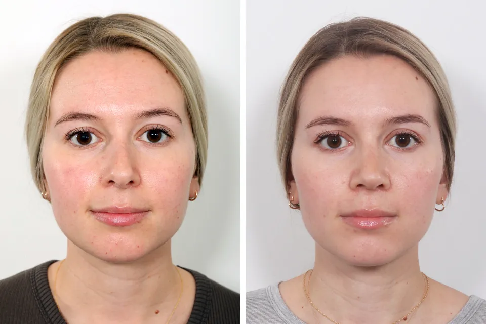 Rhinoplasty