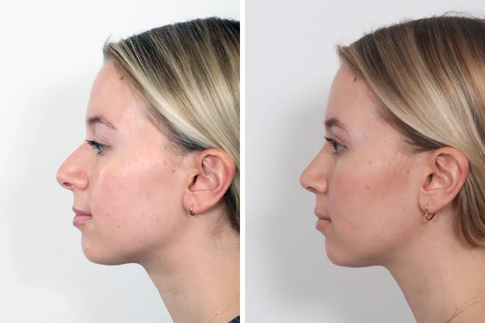 Rhinoplasty