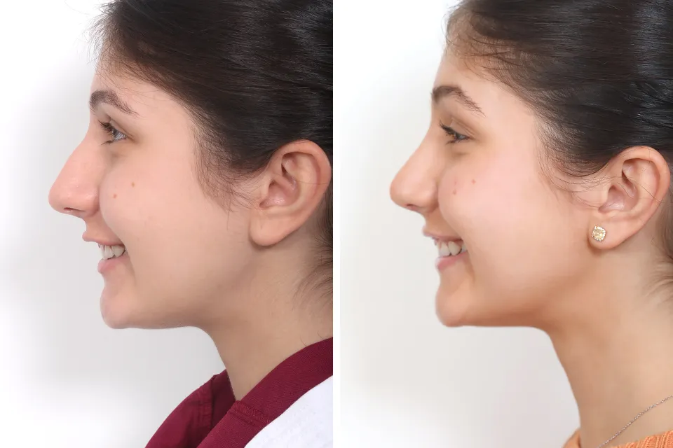 Rhinoplasty