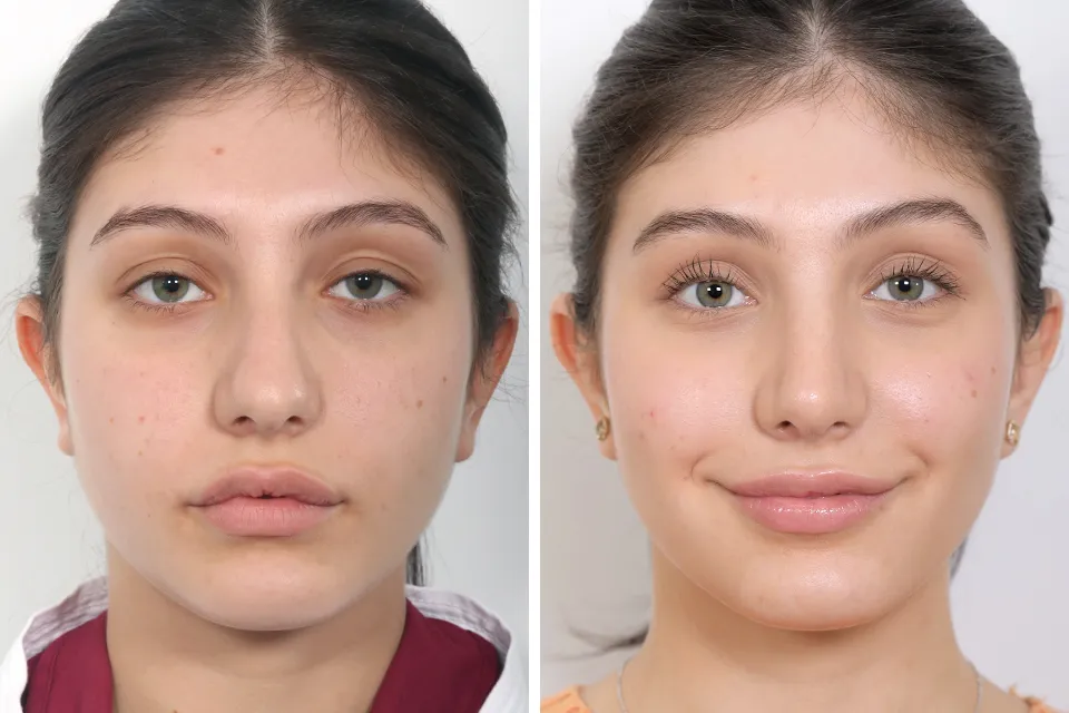 Rhinoplasty