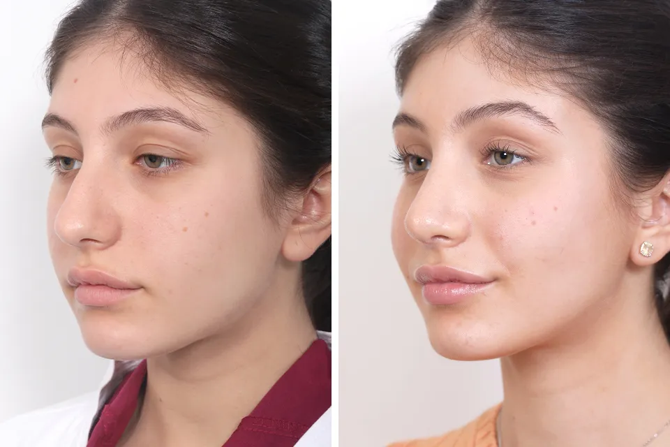 Rhinoplasty