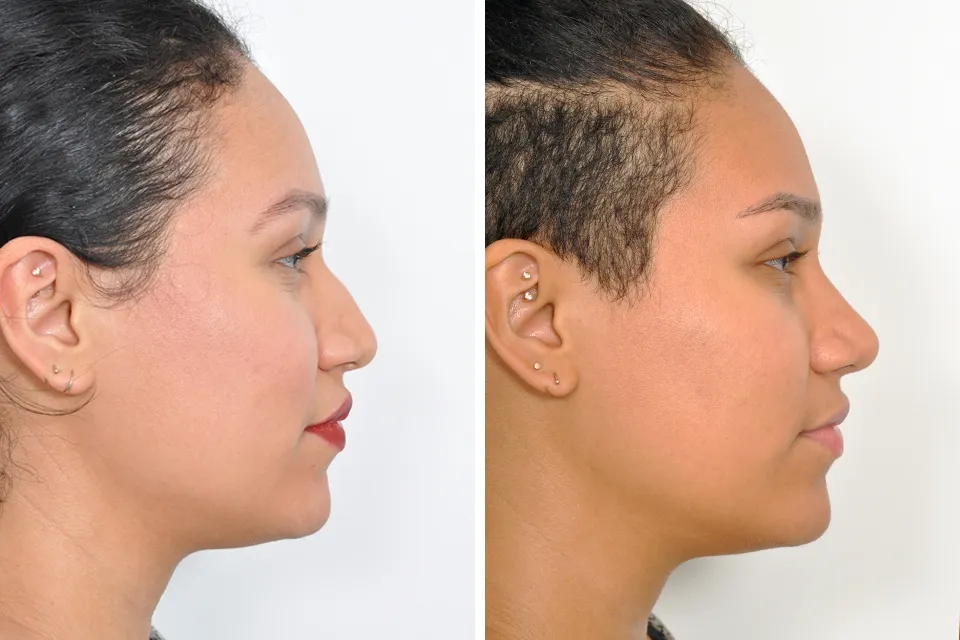 Rhinoplasty