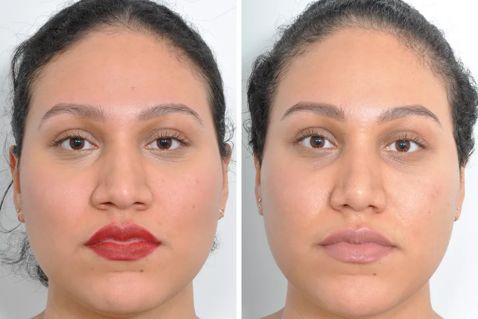 Rhinoplasty