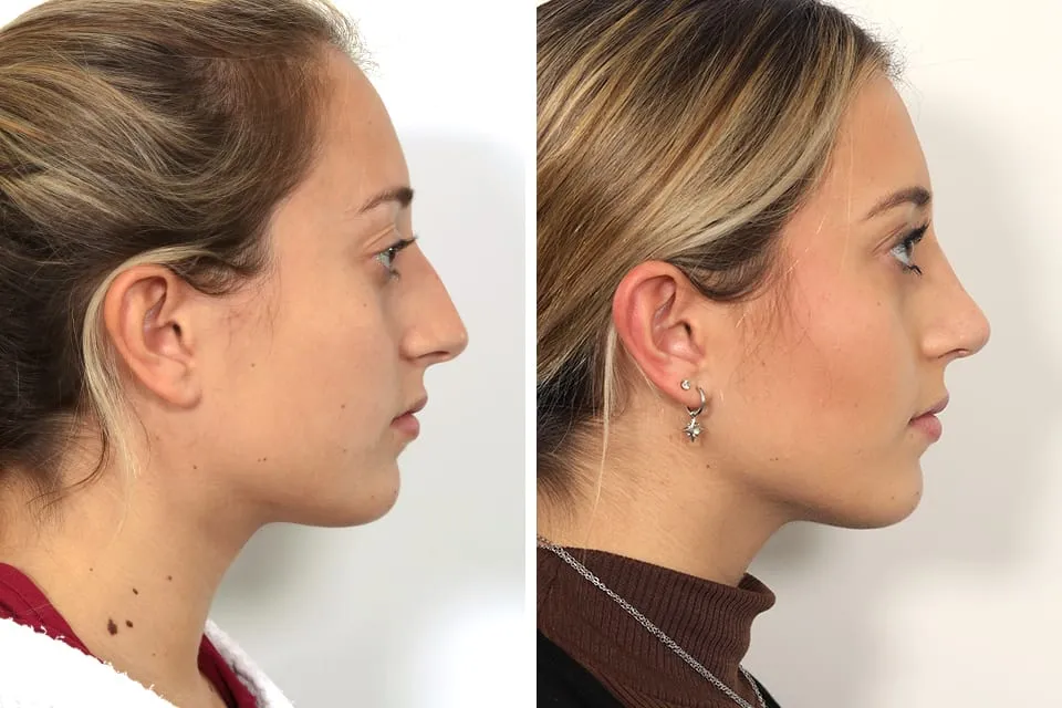 Rhinoplasty